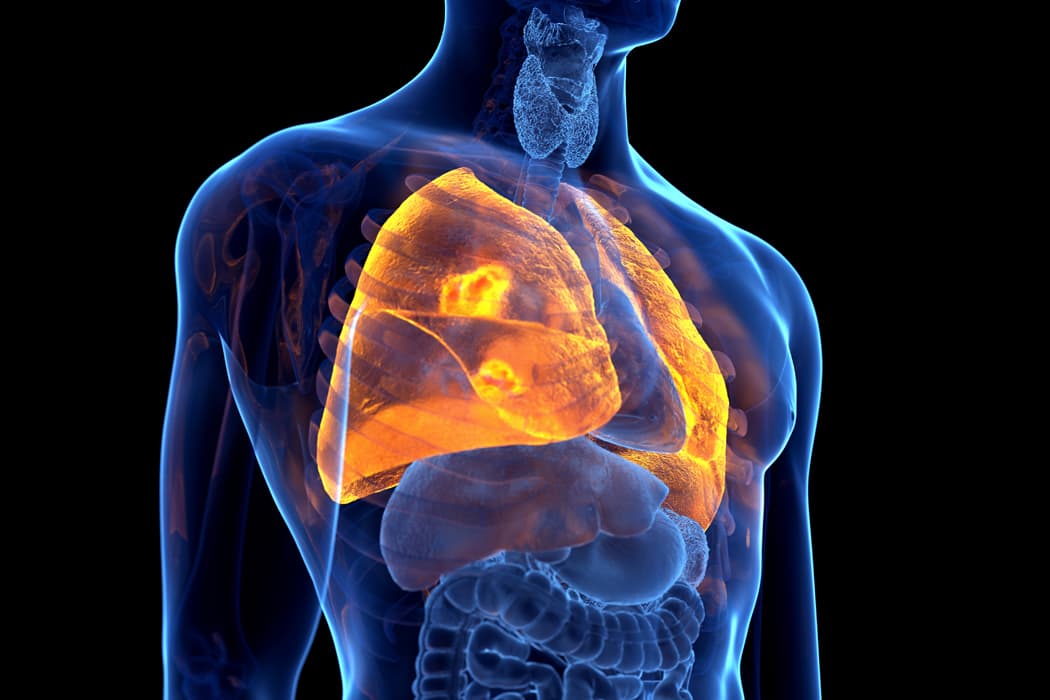 Consejos nutricionales para pacientes con cáncer de pulmón 